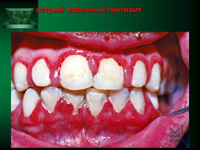 острый язвенный гингивит